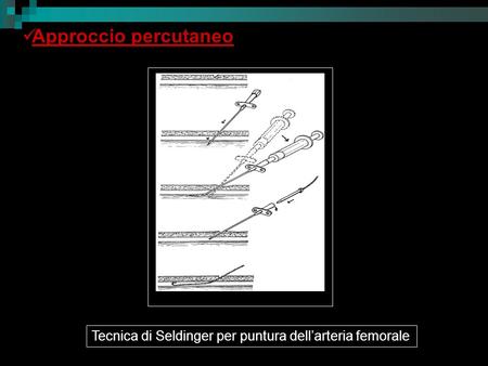 Approccio percutaneo Tecnica di Seldinger per puntura dell’arteria femorale.