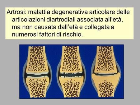 Artrosi: malattia degenerativa articolare delle articolazioni diartrodiali associata all’età, ma non causata dall’età e collegata a numerosi fattori di.