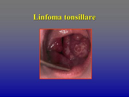 Linfoma tonsillare. Ascesso tonsillare Score clinico di Breese nella diagnosi di faringo-tonsillite da SBEGA 1 Stagionalità 2 Età 3 Febbre 4 Faringodinia.