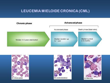 Chronic phase LEUCEMIA MIELOIDE CRONICA (CML) Advanced phase.