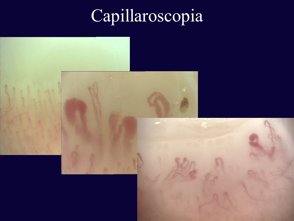 Capillaroscopia