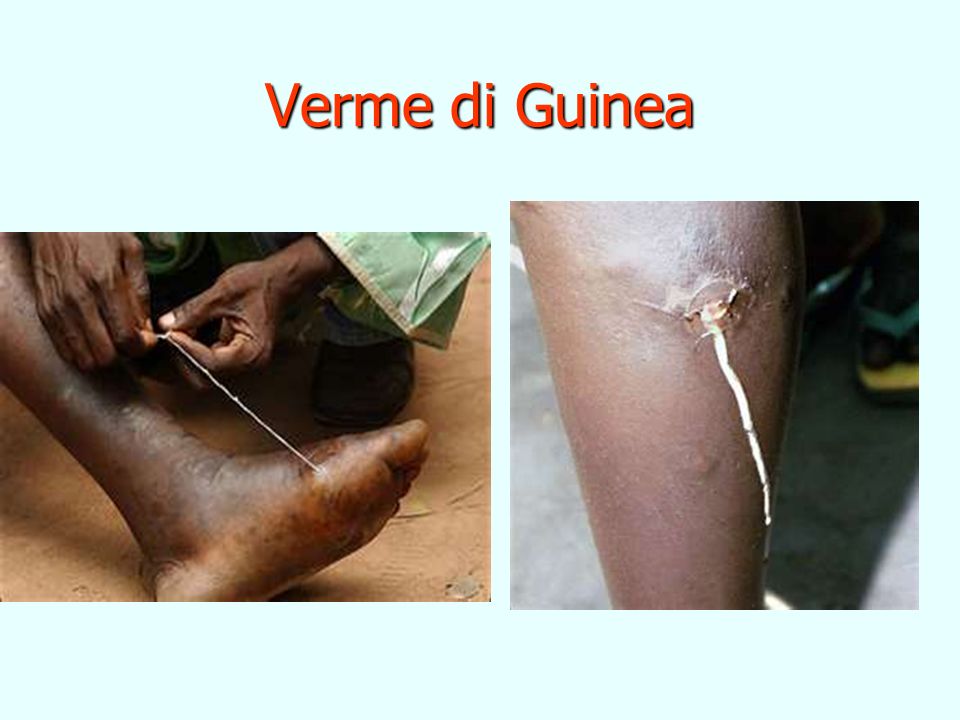Verme di Guinea