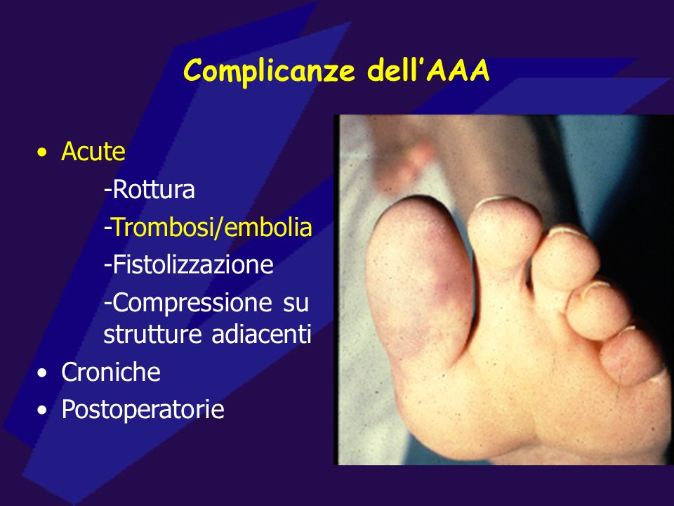 Complicanze dell’AAA Acute -Rottura -Trombosi/embolia -Fistolizzazione