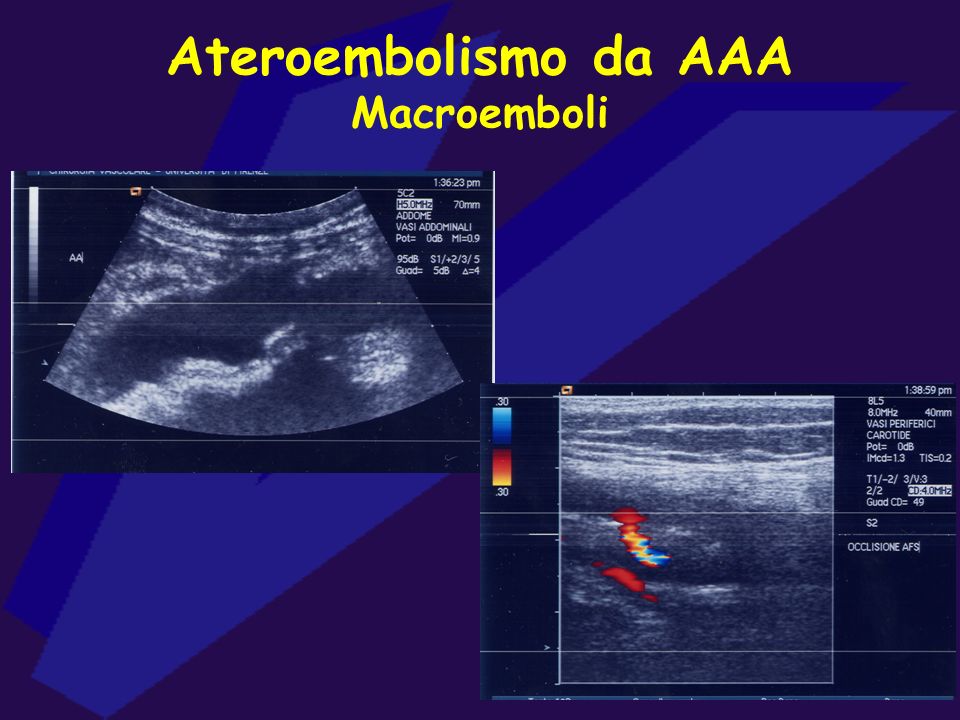 Ateroembolismo da AAA Macroemboli