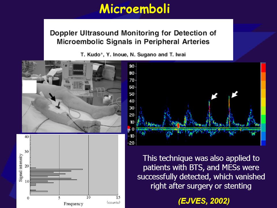 Microemboli This technique was also applied to patients with BTS, and MESs were successfully detected, which vanished right after surgery or stenting.