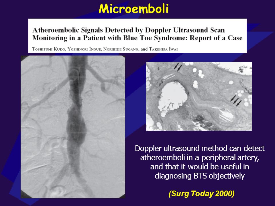 Microemboli Doppler ultrasound method can detect atheroemboli in a peripheral artery, and that it would be useful in diagnosing BTS objectively.