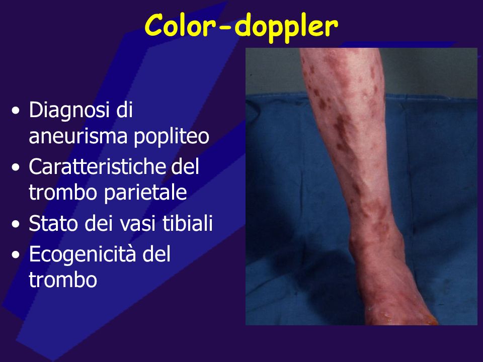 Color-doppler Diagnosi di aneurisma popliteo