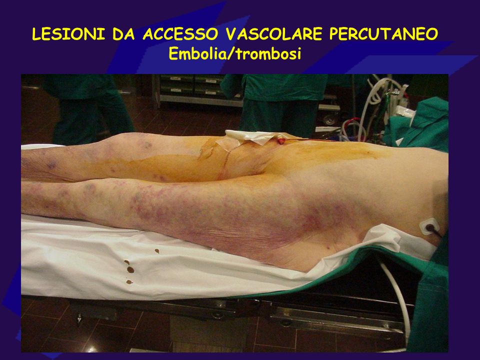 LESIONI DA ACCESSO VASCOLARE PERCUTANEO Embolia/trombosi