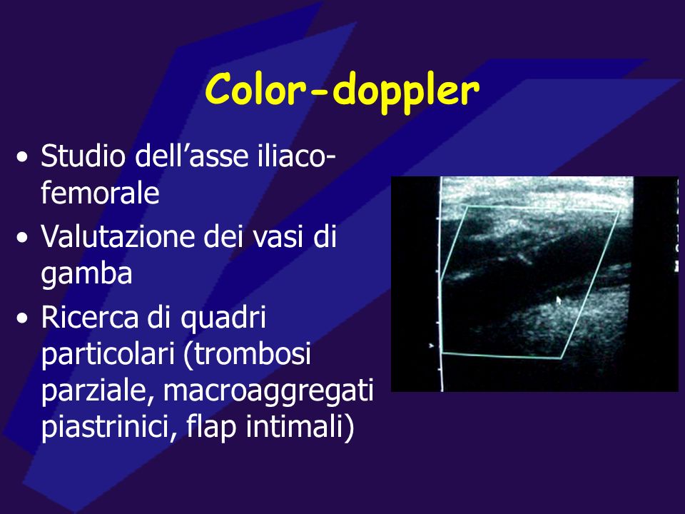 Color-doppler Studio dell’asse iliaco-femorale