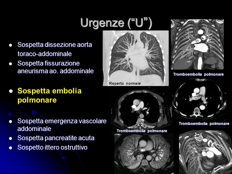 Urgenze ( U ) Sospetta embolia polmonare Sospetta dissezione aorta