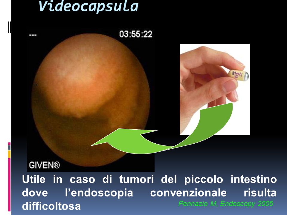 Videocapsula Utile in caso di tumori del piccolo intestino dove l’endoscopia convenzionale risulta difficoltosa.