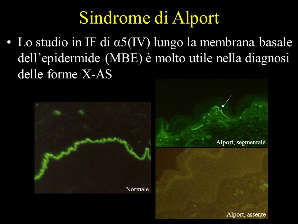 Sindrome di Alport Lo studio in IF di α5(IV) lungo la membrana basale dell’epidermide (MBE) è molto utile nella diagnosi delle forme X-AS.