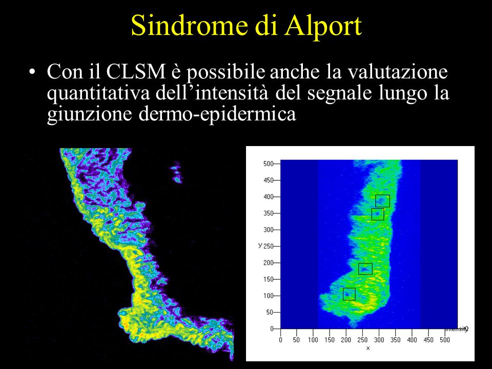 Sindrome di Alport Con il CLSM è possibile anche la valutazione quantitativa dell’intensità del segnale lungo la giunzione dermo-epidermica.
