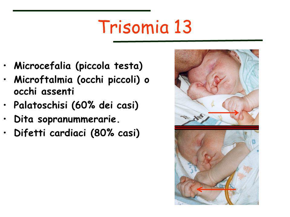 Trisomia 13 Microcefalia (piccola testa)
