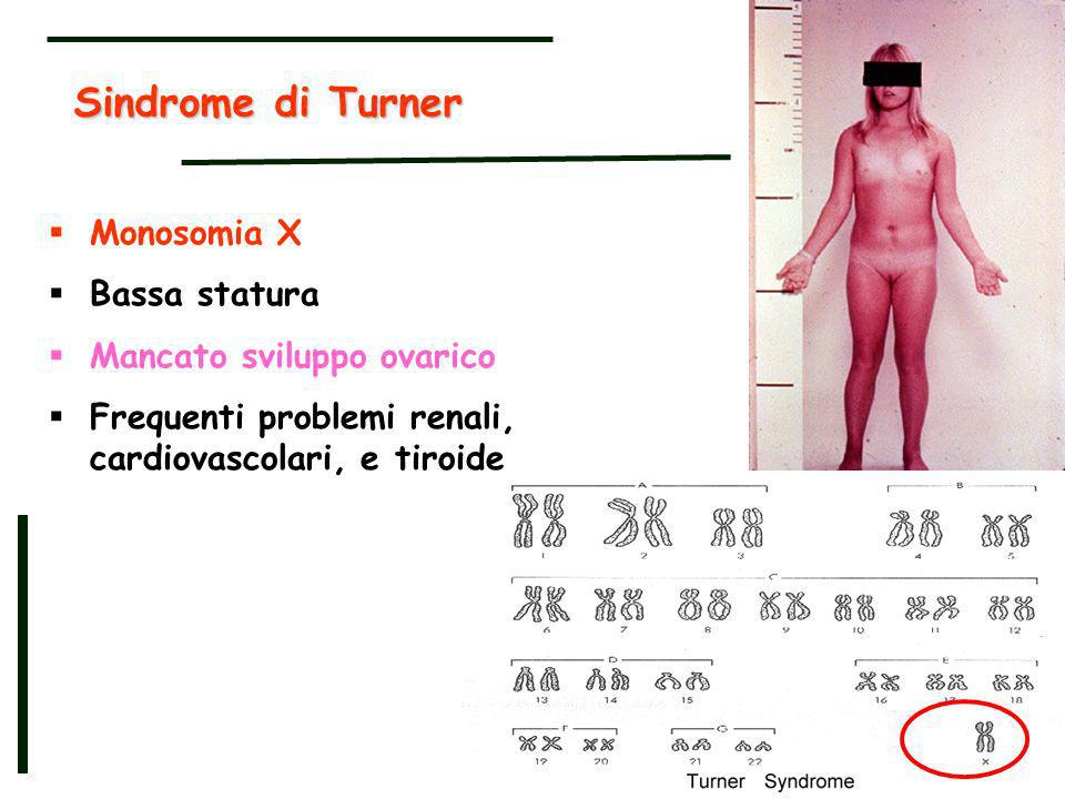 Sindrome di Turner Monosomia X Bassa statura Mancato sviluppo ovarico