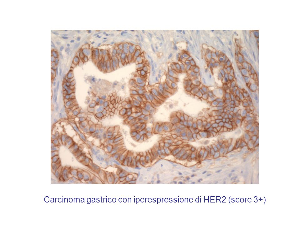 Carcinoma gastrico con iperespressione di HER2 (score 3+)