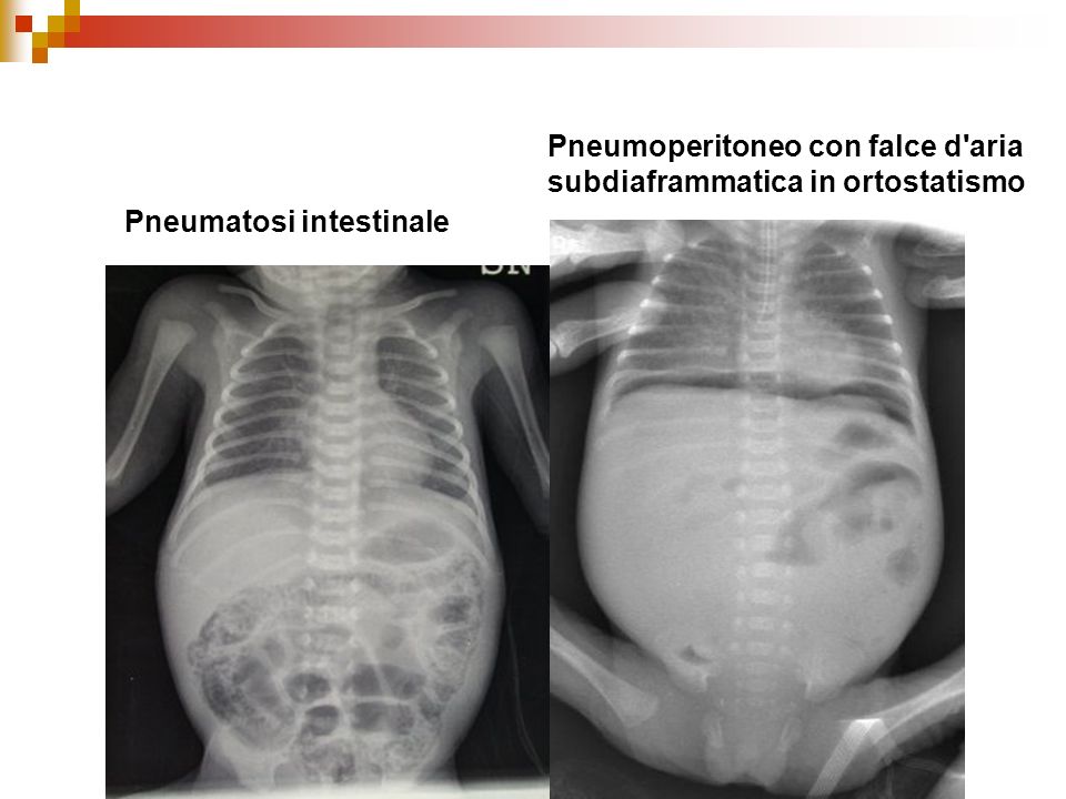 Pneumoperitoneo con falce d aria subdiaframmatica in ortostatismo