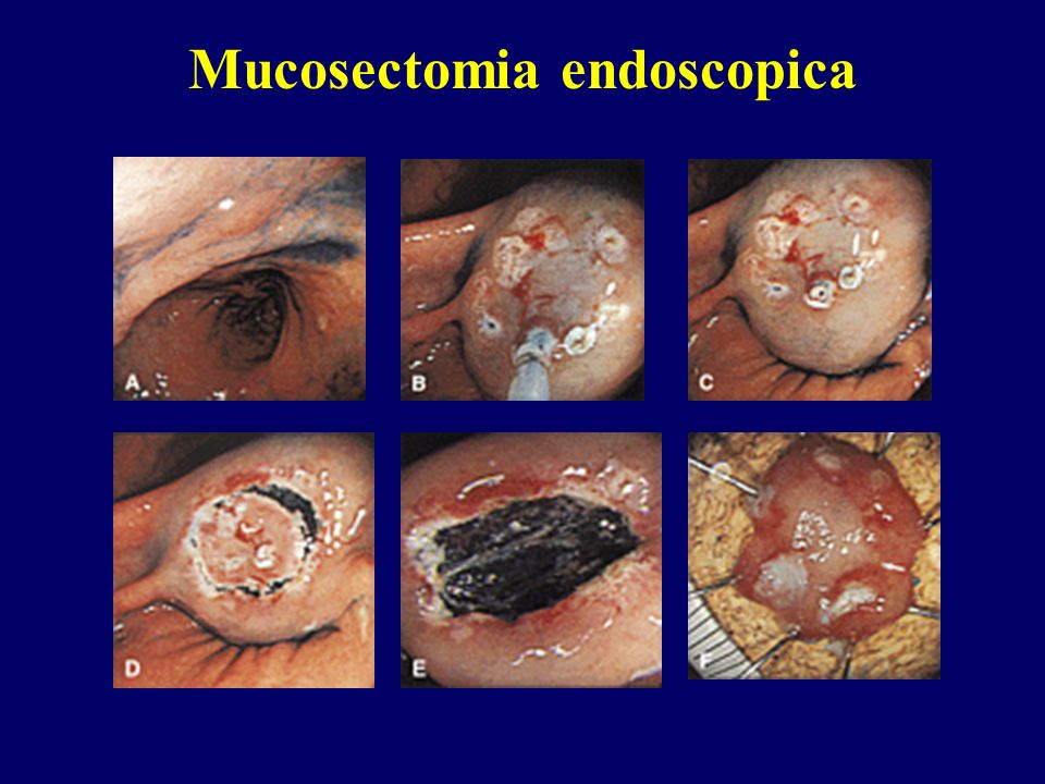 Mucosectomia endoscopica