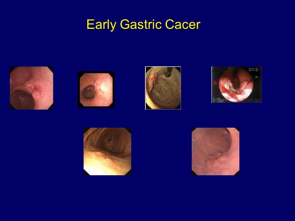 Early Gastric Cacer