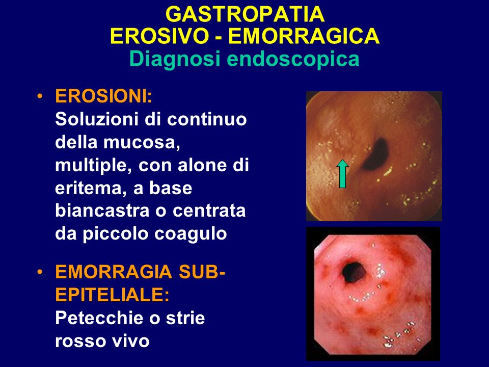 GASTROPATIA EROSIVO - EMORRAGICA Diagnosi endoscopica