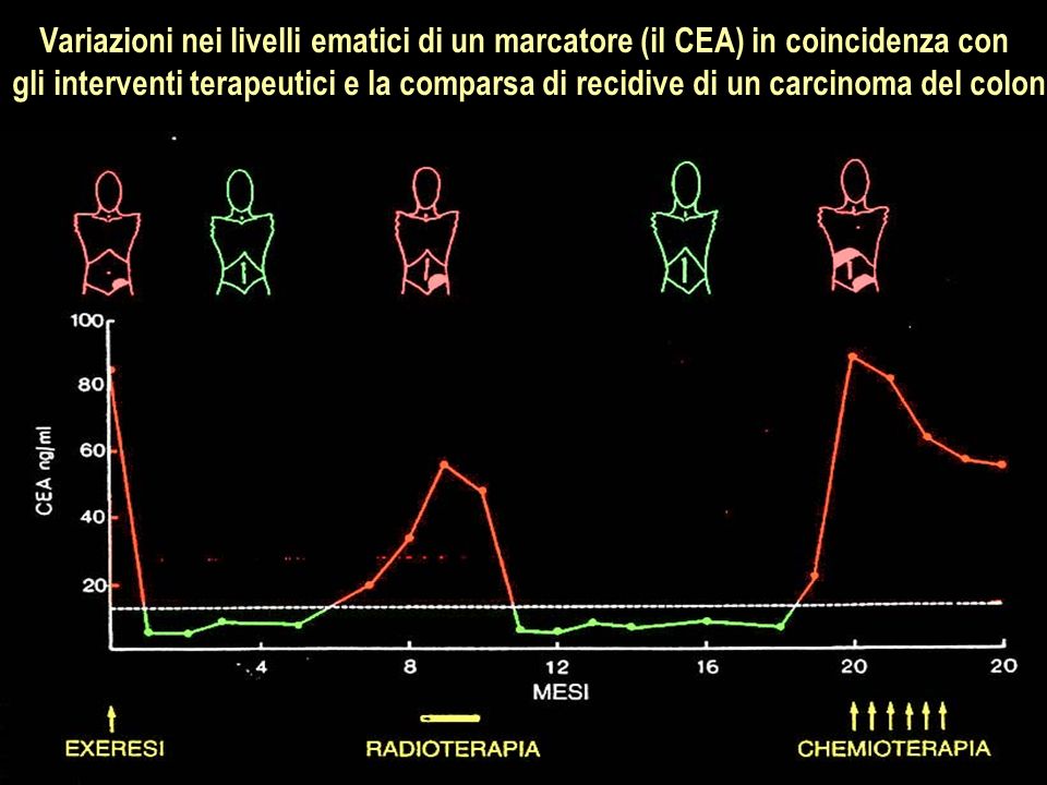 Variazioni nei livelli ematici di un marcatore (il CEA) in coincidenza con