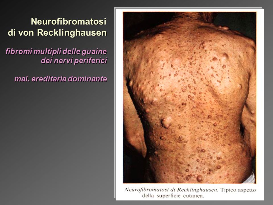 Neurofibromatosi di von Recklinghausen fibromi multipli delle guaine