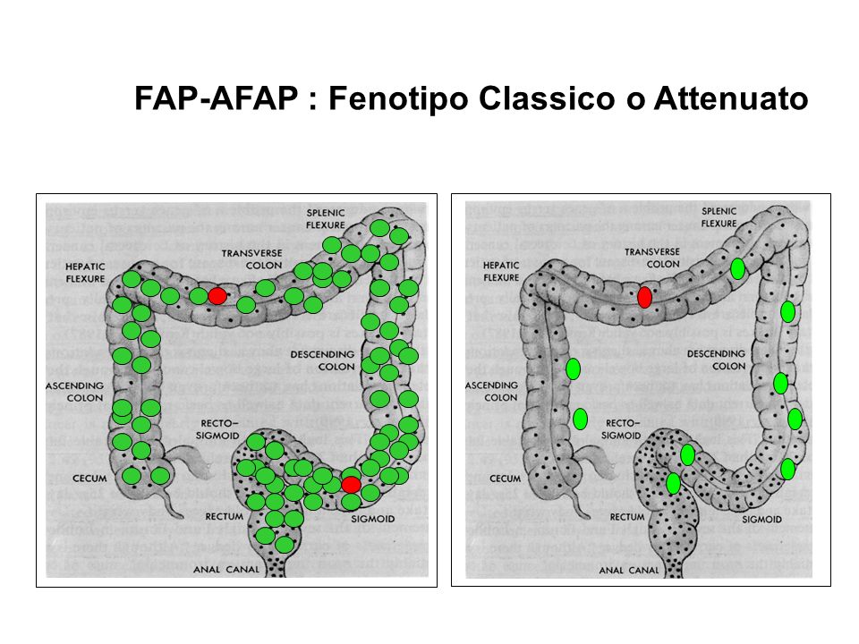 FAP-AFAP : Fenotipo Classico o Attenuato