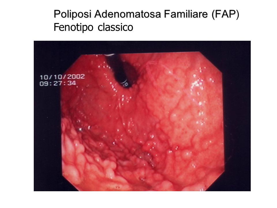 Poliposi Adenomatosa Familiare (FAP)