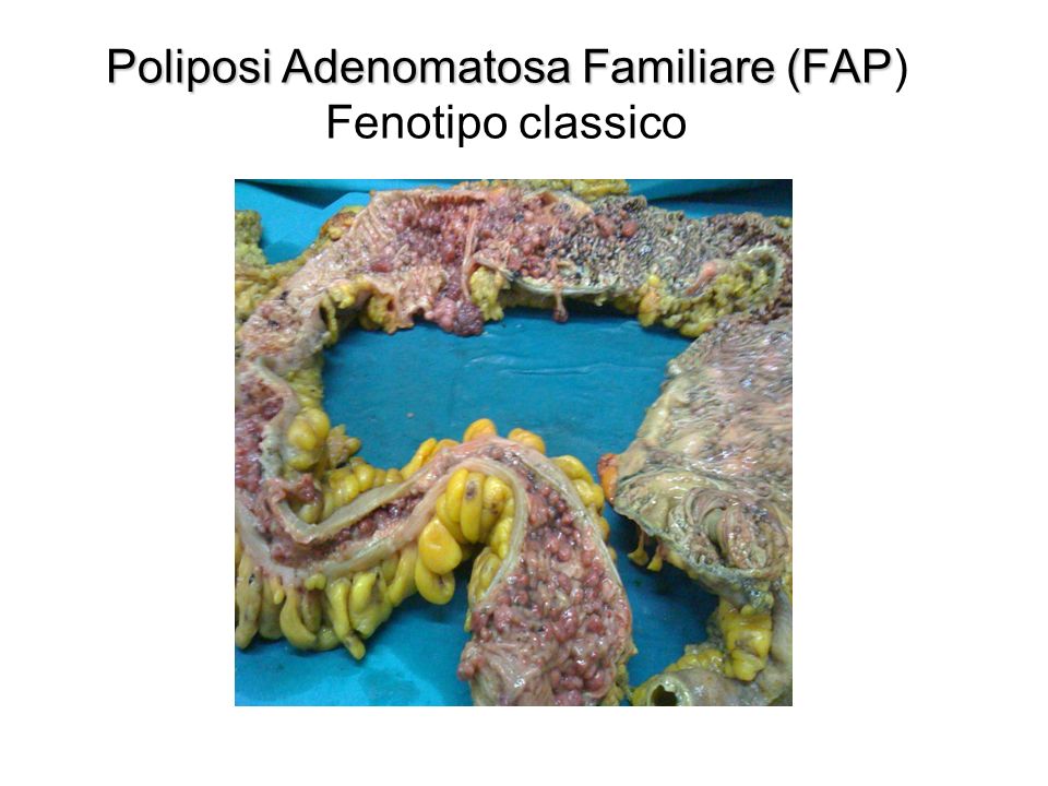 Poliposi Adenomatosa Familiare (FAP) Fenotipo classico