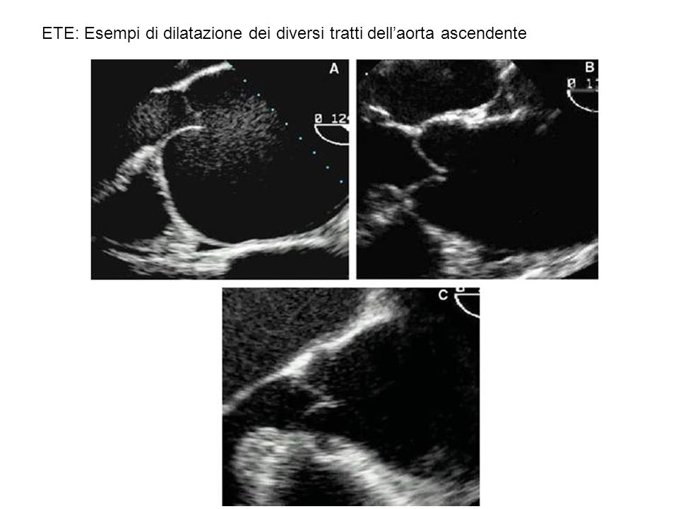 ETE: Esempi di dilatazione dei diversi tratti dell’aorta ascendente