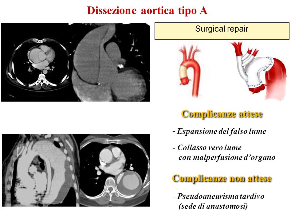 Dissezione aortica tipo A Complicanze non attese