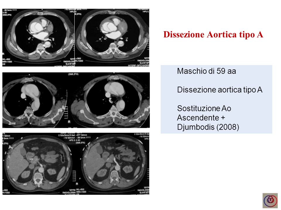 Dissezione Aortica tipo A