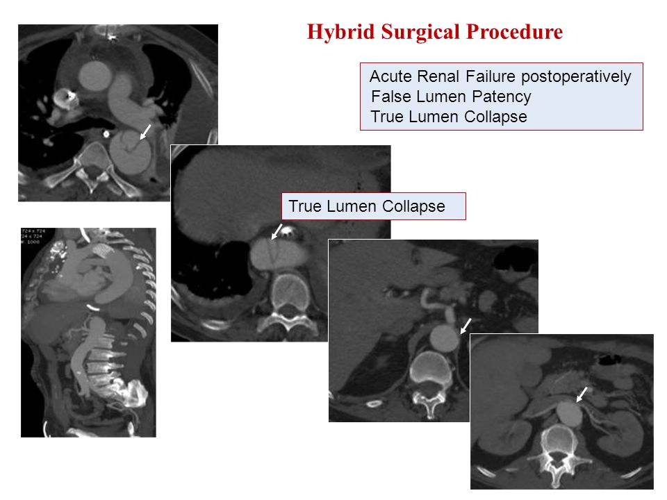 Hybrid Surgical Procedure