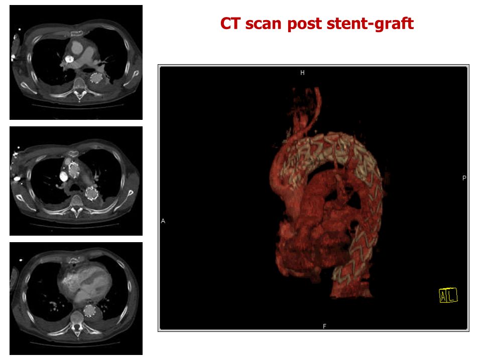 CT scan post stent-graft