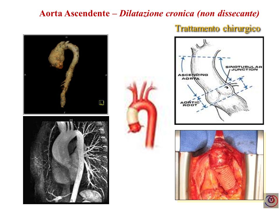 Aorta Ascendente – Dilatazione cronica (non dissecante)
