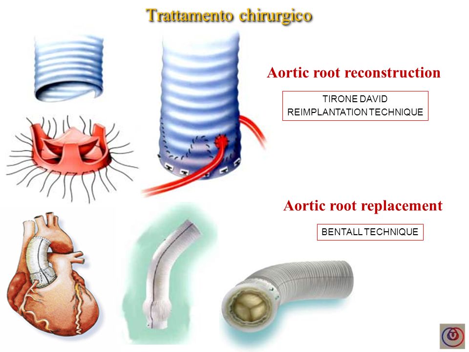 Aortic root reconstruction Aortic root replacement