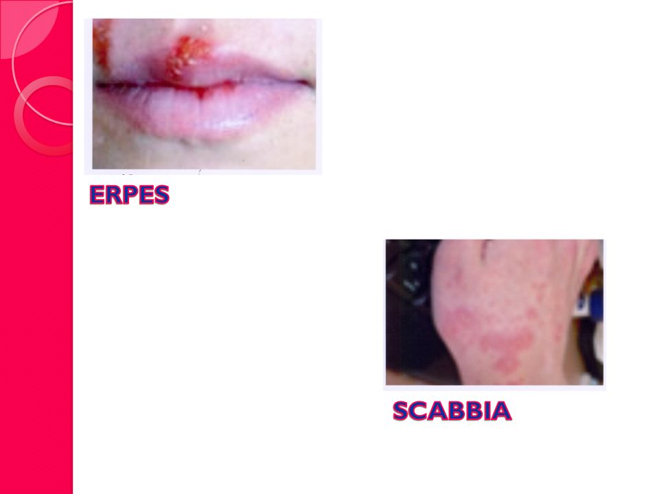 ERPES SCABBIA