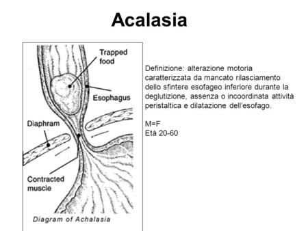 Acalasia Definizione: alterazione motoria caratterizzata da mancato rilasciamento dello sfintere esofageo inferiore durante la deglutizione, assenza o.