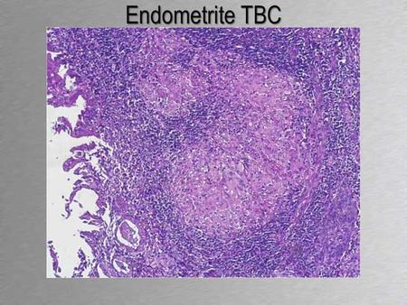 Endometrite TBC.
