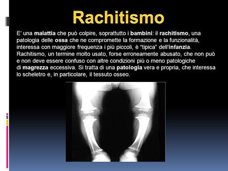 Rachitismo E’ una malattia che può colpire, soprattutto i bambini: il rachitismo, una patologia delle ossa che ne compromette la formazione e la funzionalità,