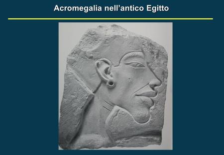 Acromegalia nell’antico Egitto