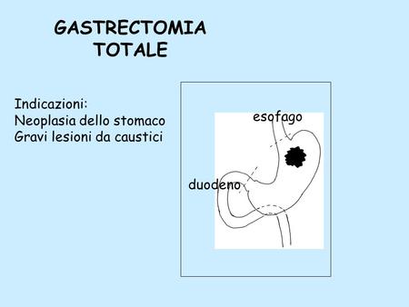 GASTRECTOMIA TOTALE Indicazioni: Neoplasia dello stomaco esofago