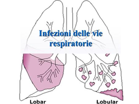 Infezioni delle vie respiratorie