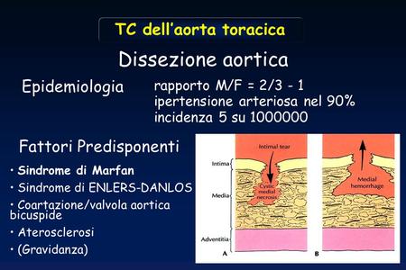 Dissezione aortica TC dell’aorta toracica Epidemiologia