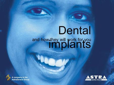 Dental implants and how they will work for you.