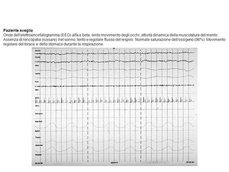 Paziente sveglio Onde dell'elettroencefalogramma (EEG) alfa e beta, lento movimento degli occhi, attività dinamica della muscolatura del mento. Assenza.