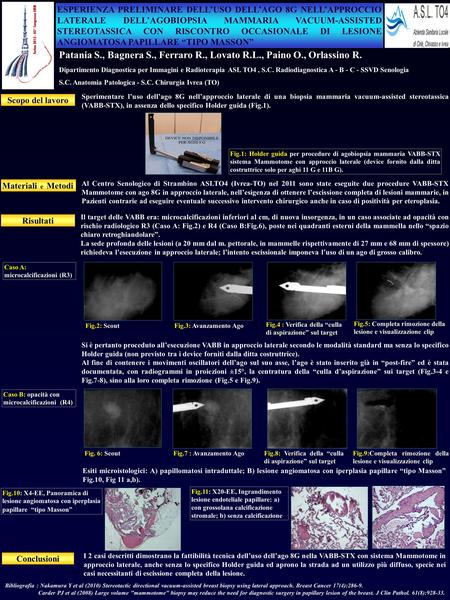 ESPERIENZA PRELIMINARE DELL’USO DELL’AGO 8G NELL’APPROCCIO LATERALE DELL’AGOBIOPSIA MAMMARIA VACUUM-ASSISTED STEREOTASSICA CON RISCONTRO OCCASIONALE DI.