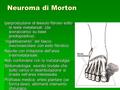Neuroma di Morton Iperproduzione di tessuto fibroso sotto le teste metatarsali. (da sovraccarico su base predispositiva). “ingabbiamento” del fascio neurovascolare.