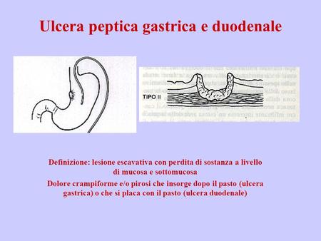 Ulcera peptica gastrica e duodenale Definizione: lesione escavativa con perdita di sostanza a livello di mucosa e sottomucosa Dolore crampiforme e/o pirosi.