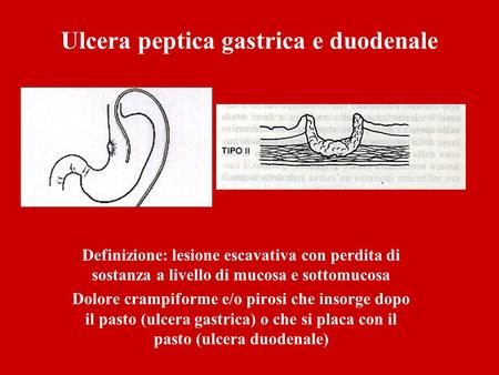 Ulcera peptica gastrica e duodenale